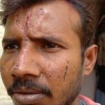 Trishul Carved Into UP Man’s Forehead, ‘Holi Colour Reacted,’ Say Police