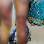 Lucknow: Dalit youth brutally thrashed by cops, alleges third-degree torture
